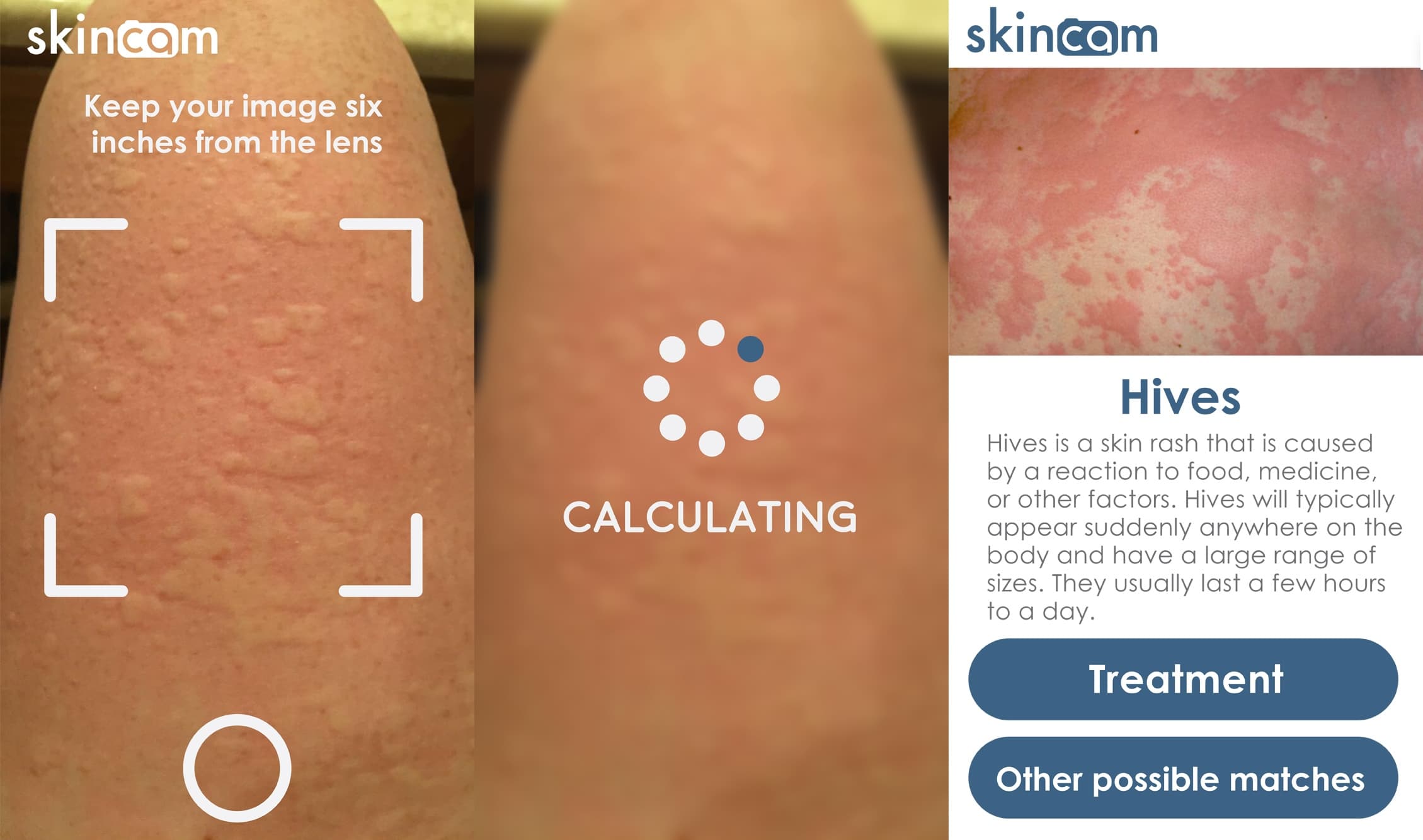 skinCAM: AI-powered skin disease identification app